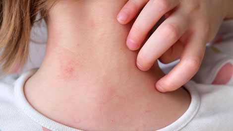 patient requiring frequent rash treatment in San Clemente CA